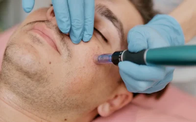 How Does Microneedling Treat Acne Scars?