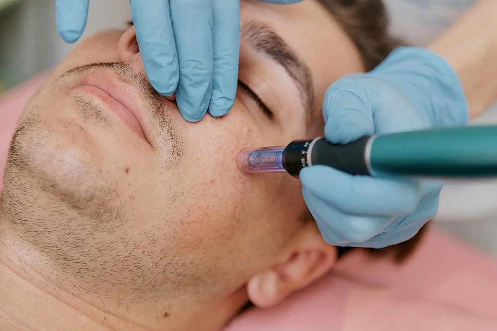 How Does Microneedling Treat Acne Scars?