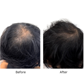 PHP Hair Therapy Restoration in Rochester, NY | Vitalize Medical & Aesthetics