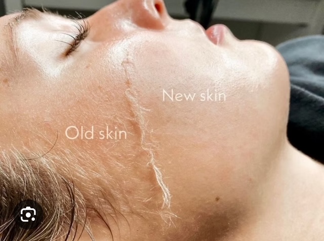 image0 (5) Dermaplaning services at Vitalize Medical & Aesthetics
