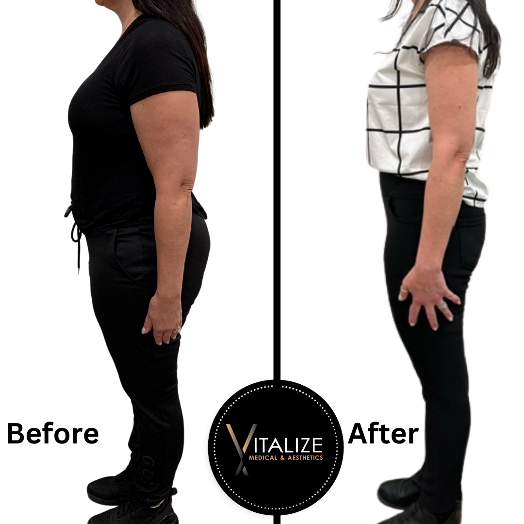 Before and After Semaglutide treatment