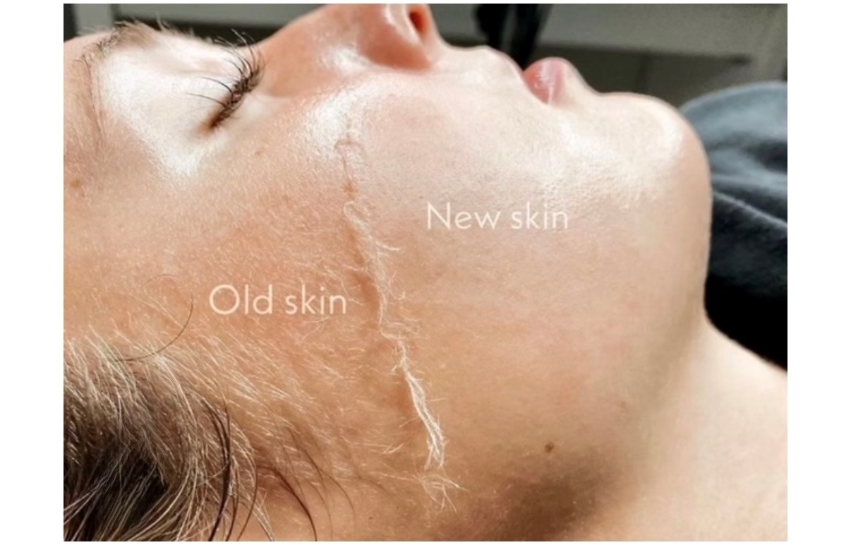 Dermaplaning services at Vitalize Medical & Aesthetics